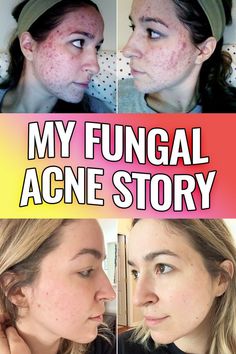 Nizoral For Fungal Acne, Yeast Acne, Fungal Acne Skin Care Routine, Forehead Breakout, Bacterial Acne, Expensive Products, Acne Diet, Healthy Healing, Fungal Acne