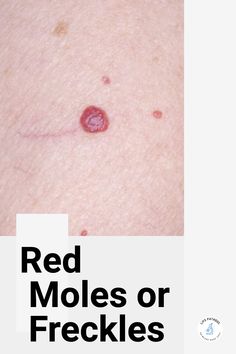 Red moles or freckles on the skin are very common. Often these red spots are just cherry angiomas which are non-cancerous skin growths. These are usually seen in people over the age of 30 years. However, other skin lesions can appear similar to red moles and it is important to identify them to avoid missing skin lesions like skin cancer. Red Moles On Skin, What Causes Pimples, Pimples On Buttocks, Redness Pimple, Red Freckles, Skin Lesions