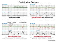 Maternal Nursing, Fetal Monitoring, Fetal Heart Rate, Nurse Teaching, Veal Chop, Ob Nurse, Child Nursing, Ob Nursing