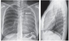 Left upper lobe atelectasis. Frontal (C) and lateral (D) chest radiographs in a patient shows left upper lung opacity obscuring the left mediastinal interfaces. On the frontal (C) radiograph, there is a subtle left juxtaphrenic peak (short arrow) representing an inferior accessory fissure tenting the left hemidiaphragm as a result of left upper lo be volume loss. A lucency (long arrow) outlining the aortic knob represents compensatory hyperinflation of the superior segment of the left lower lobe