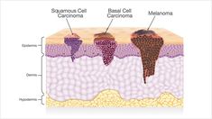 Sarcoma Awareness Month, Sarcoma Awareness, Body Tissues, Pelvic Pain, Laser Therapy, Professions