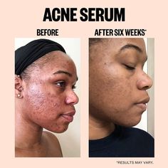 Salicylic Acid Treatment Serum - Peace Out | Sephora Peace Out Acne, Skincare Content, Skin Facts, Health Poster, Acne Skincare, Black Skin Care, Natural Acne Remedies, Salicylic Acid Acne, Acne Serum