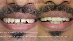 Any adult having teeth with gaps, crooked teeth, over sized, small teeth, dark teeth, protruding or fractured teeth is a candidate for smile makeover. This treatment is not a surgery and your teeth can be straightened or corrected without braces/orthodontic treatment and can be completed in just 5-7 days in 2-3 visits. Visit : www.allsmilesdc.org Over Sized