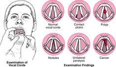 Overview of Laryngeal Disorders - Ear, Nose, and Throat Disorders - Merck Manuals Professional Edition Speech Language Pathology Grad School, Voice Therapy, Speech Path, Speech Therapy Materials, Speech Therapy Resources, Human Anatomy And Physiology, Medical Anatomy, Speech Therapist, Speech Pathology