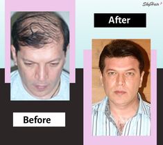 You might have noticed that Aditya Pancholi often switching up their hair looks. No Secrets, he also uses hair patches to change his looks; you can too. #hair #hairstyle #hairpatch #menhairpatch #hairwig #beauty #fashion Aditya Pancholi, Skin Care Remedies, Foods To Avoid, Beauty Fashion, Hair Looks, Mens Hairstyles, Shaving