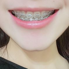 Perfect Teeth Braces, Smile Tips, Braces Smile, Ceramic Braces, Braces Tips, Membentuk Alis