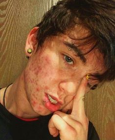 a young man with freckles on his face looking at the camera while holding his hand to his cheek