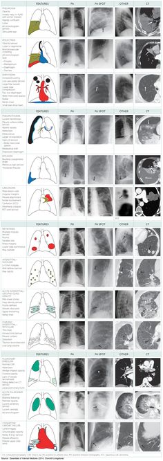 an image of the chest with different types of lungs and their corresponding functions in each region