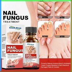 Toenail Fungal Infection, Nail Problems, Nail Infection, Fungal Nail, Oregano Oil, Nail Repair, Nails Today, Damaged Nails, Take Off Your Shoes