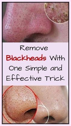 #BeautyRoutine#SkincareTips#GlowUp#SkincareAddict#BeautyCare#SkinGoals#SkincareJunkie#HealthySkin#BeautyTips#NaturalBeauty#SkincareProducts#RadiantSkin#CleanBeauty#SelfCare#SkincareLovers# Small Pimples, Beauty Hacks That Actually Work, Hairstyles Bun, Cold Sores Remedies, Remove Blackheads, Hairstyles Volleyball, Get Rid Of Blackheads, Natural Cough Remedies, Healthy Skin Tips