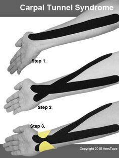 Kinesiotaping for the UE Carpal Tunnel Taping, Kt Tape For Carpal Tunnel, Kt Tape Carpal Tunnel, Carpal Tunnel Kt Taping, Carpal Tunnel Exercises, Occupational Therapy Assistant