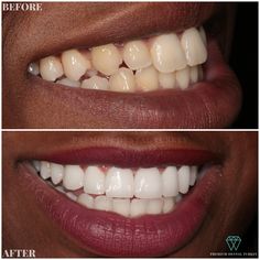 Smile Makeover in Turkey. Get free quote for your dental treatment in Turkey and save 70% Teeth Whitening Mouthwash, Teeth Veneers, Dental Implant Surgery, Office Logo, Dentist Visit, Teeth Bleaching, Dentist Appointment, Teeth Implants, Skin Gel