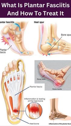 Plantar fasciitis (that second word pronounced fash-ee-eye-tis) is a condition in which you are experiencing pain in your plantar fascia, the tendon that connects your heel to your toes, which reveals itself in a variety of foot pains. Most notably, when you step on your foot after a night of rest and you feel unable to put any pressure on your foot as it sends a shooting pain to your heal and throughout your foot. Plantar fasciitis if not treated can become a chronic condition. Cool Down Stretches, Plantar Fascia, Ankle Pain, Foot Pain Relief