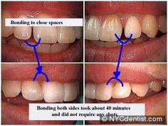 Teeth Bonding, Dental Ceramics, Baby Tooth Decay, Dentistry Office, Dental Health Care, Brace Face