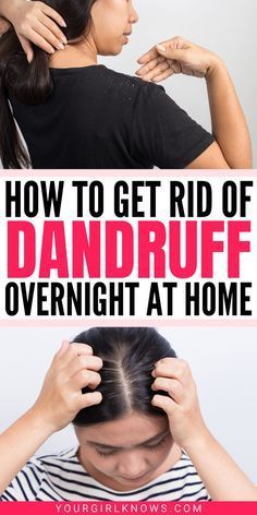 What Is Dandruff, How To Remove Dandruff, Severe Dandruff, Natural Dandruff Remedy, Hair Mask For Dandruff, Dandruff Solutions, Dandruff Hair