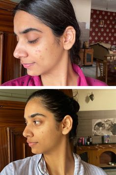 Here Are 11 Best The Ordinary Products For Acne Scars That CHANGED My Skin Acne Scarring Treatment, Facial Scars, Oily Skin Care Routine