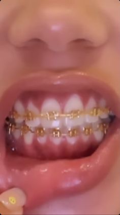 Straight Teeth With Braces, Gold Braces Teeth, Gold Braces With Color Bands, Pretty Braces Colors, Neon Green Braces, Braces Colors Aesthetic, Colored Braces, People With Braces