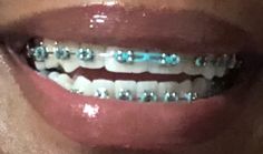 Braceface Aesthetic, Teeth Aesthetic Braces, Cute Braces With Rubber Bands, Navy Blue Braces Teeth, Powerchain Braces Aesthetic, Cute Braces Colors Aesthetic, Baby Pink Braces, Pretty Braces Colors, Braces Colors Aesthetic