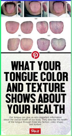 t Does Your Tongue Say About Your Health? #TongueHealthDiagnosis #TongueColorHealth Tongue Sores, Tongue Health, Health Signs, The Tongue, Nail Health, Lose 40 Pounds, Traditional Chinese Medicine, Wellness Tips, Our Body