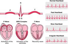 ECG. Ekg Interpretation, Ecg Interpretation, Respiratory Therapy, Heart Rhythms, Nursing School Notes, Nursing Education