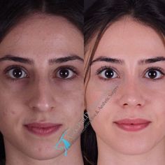 Revision Rhinoplasty, Crooked Nose, Rhinoplasty Before And After, Best Plastic Surgeons, Pretty Nose