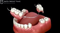 Removable Partial Denture, Prosthetic Teeth, Guillain Barre Syndrome, Broken Doll, Dental Cosmetics, Dentures