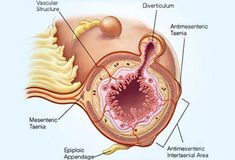 What Foods Should You Avoid If You Have Diverticulosis? Prevent Constipation, Digestive Juice, Feeling Nauseous, High Fiber Diet, Signs And Symptoms, Pain Relief