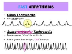 Arrythmias Heart, Supraventricular Tach, Function Of Heart, Osce Exam, Ekg Rhythms, Cardiology Nursing, Ekg Interpretation