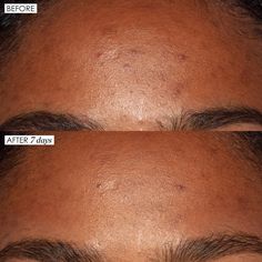 Good Genes deeply exfoliates the dull surface of the skin for instant glow and radiance. As dull, dead surface cells are removed, clarity and smoothness are restored. Good Genes visibly brightens the appearance of dark spots and discolorations and instantly plumps the look of fine lines and wrinkles in 3 minutes. This multi-tasking, targeted lactic acid treatment rapidly exfoliates and boosts naturally youthful radiance, while visibly reducing the look of lines, wrinkles, and dark spots. High po Aha Serum, Skin Bumps, High Hair, Congested Skin, Good Genes, Sunday Riley, Get Rid Of Blackheads, Clearer Skin, Skin Disorders