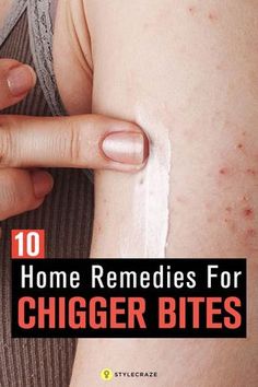 Bite Relief, Tick Bite, Diy Remedies, Bug Bites, Medical Knowledge