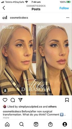 Facial Contouring Fillers, Botox Eyebrow Lift Before And After, Cheekbone Filler Before And After, Face Contouring Fillers, Botox Jawline Before And After, Under Eye Filler Before And After, Jawline Fillers Before And After, Cheek Fillers Before And After Face, Chin Fillers Before After