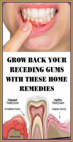 Rebuilds Your Teeth and Gums - 60-Second Trick Rebuilds Your Teeth and Gums Overnight by Overall Health Care | This newsletter was created with Smore, an online tool for creating beautiful newsletters for educators, nonprofits, businesses and more Grow Back Receding Gums, Gum Inflammation, Gum Recession, Tooth Pain, Tooth Sensitivity