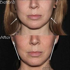 Slim Cheeks Aesthetic, Masseter Botox Injection, Chin Botox Before And After, Jaw Botox Before After, Fillers Before And After, Cheek Fillers Before And After Face, Masseter Botox Before And After, Botox Before After, Masseter Muscle