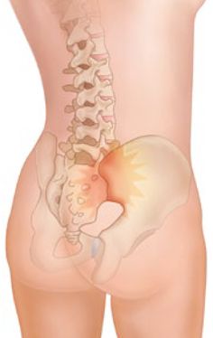 Sacroiliac Joint Dysfunction. | Osteopath in Hatfield Inflammatory Recipes, Nerve Health, Body Joints, Sciatica Pain, Back Pain Exercises