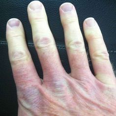 Learn about CREST syndrome & systemic sclerosis. What are causes, signs, symptoms, diagnosis, treatment & prognosis of CREST syndrome and systemic sclerosis Purple Nail Beds, Blue Fingernails, Ehlers Danlos Syndrome Types, Pulmonary Function Test, Nail Beds, Lung Disease, Purple Nail, Ehlers Danlos Syndrome