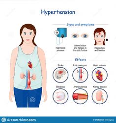 Illustration about Hypertension. Signs, symptoms, and Effects of High blood pressure. Vector illustration. Infographic. Illustration of kiidney, hanges, aneurysm - 213830720 Hypertension Symptoms Signs, Hypertension Poster, Salt Logo, Nurse Study, Illustration Infographic, Brain Surgeon, Cardiovascular Disorders, Nurse Study Notes, Natural Face Cleanser