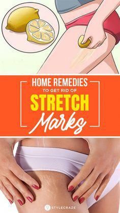 There are many home remedies to remove stretch marks. In this article, we have discussed 29 ways to fade stretch marks using simple ingredients. Check them out. Strech Marks Remedies, Strech Marks, Stretch Mark Remedies, Stretch Mark Cream, Stretch Mark Removal, Home Remedy For Cough, Cold Sores Remedies, Sleep Remedies, Natural Sleep Remedies