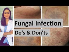 #darkinnerthigh - YouTube Fungal Infection Remedies, Skin Fungus, Fungal Infection Skin, Health Facts Food, Skin Bumps, Skin Growths, Natural Health Care, Diy Jacket, Do's And Don'ts