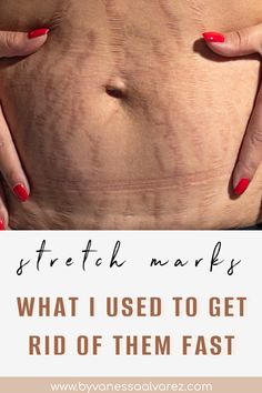 Say Goodbye to Stretch Marks: Remedies for Moms During & After Pregnancy Body Acne Remedies, My Biggest Fear, Stretch Mark Remedies, Purple Streaks, Mom Belly, Doula Business, How To Fade, Biggest Fear, Natural Skin Care Ingredients