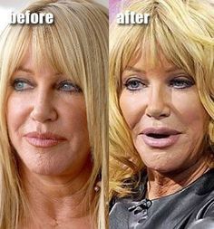 Celebrity Surgery, Cheek Implants, Plastic Surgery Fail, Chin Augmentation, Botox Lips, Plastic Surgery Gone Wrong, Body Makeover, Celebrity Plastic Surgery, The Kardashians