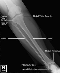 an x - ray view of the elbow and tendus, labeled in text below