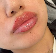 Russian Lips Filler 1ml, Lip Filler Inspiration 1ml, Round Lips Filler, Russian Lip Filler Technique, Lip Fillers Before And After 1ml, Type Of Lips, Russian Lips Filler, Lip Pmu