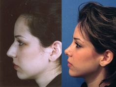 Nose inspo Persian Nose, Rhinoplasty Recovery, Hair Implants