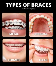 How To Put Braces On Teeth, Type Of Smiles, Color Of Braces, Star Braces, Braces Types, Brackets Aesthetic, Perfect Teeth Braces, Types Of Smiles, Different Types Of Teeth