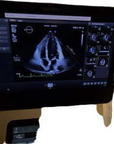 an x - ray image of a person's breast on a computer screen