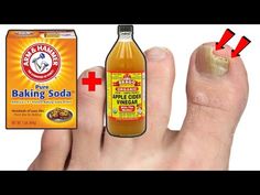 How to Cure Nail Fungus - How to Get Rid of Toenail Fungus Fast and Naturally - Get Rid of Fungus - YouTube Baking Soda Nails, Apple Cider Vinegar Mother, Toenail Health, Toenail Fungal Infection, Nail Remedies, Antifungal Cream, Fungal Nail