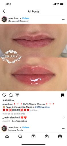 Pouty Lips Injections, Lip Filler Pouty Lips, Lip Filler Inspiration Natural, Lip Inspo Filler, Natural Looking Lip Fillers, Hip Filler, Lip Filler Shapes, Pouty Lip Filler, Lip Filler Natural