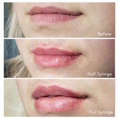 lips before and after lip fillers