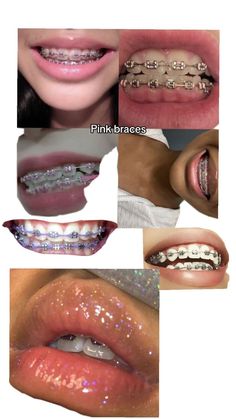 préventif Hot Pink Braces, Braces Colors