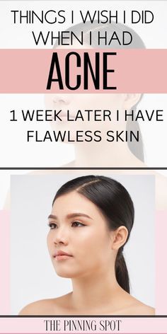 How to clear acne almost overnight and have beautiful skin (I wish I had done this when I had acne) Acne Scab, Acne Scaring, Pimple Scars, Post Acne Marks, Oily Skin Acne, Beauty Makeover, Natural Acne Remedies